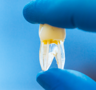 Cos’è la devitalizzazione del dente?