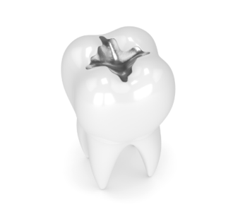 L&#8217;amalgama dentale è tossico: mito o realtà?