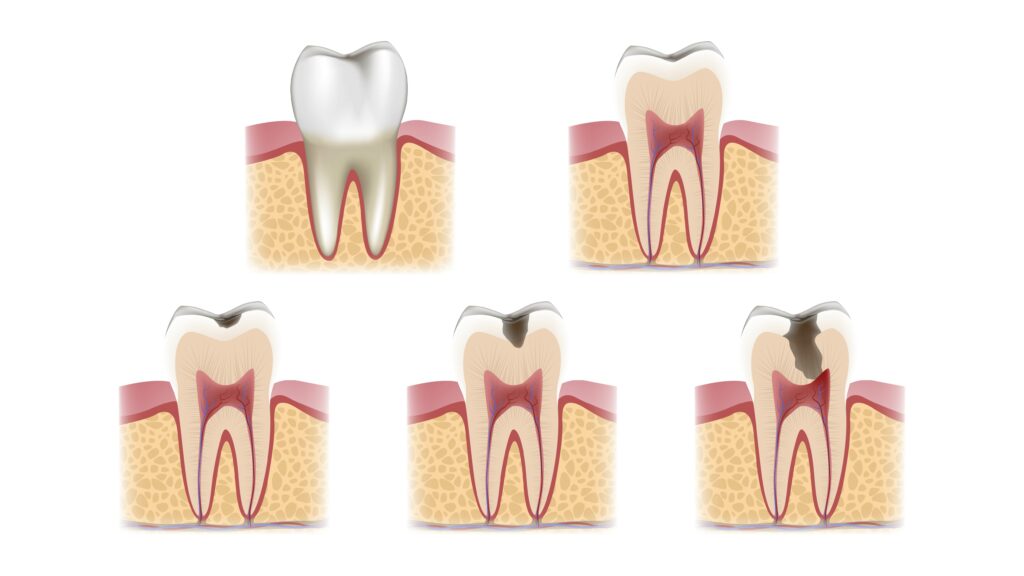 la progressione della carie dentale