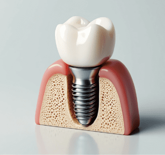 Mini impianti dentali: pro e contro